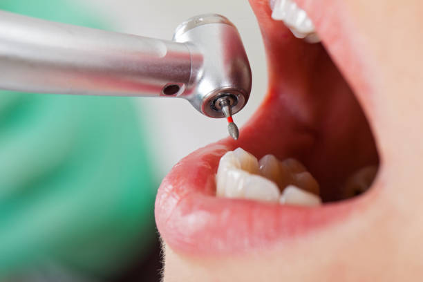 Best Emergency Wisdom Teeth Removal in Treasure Lake, PA